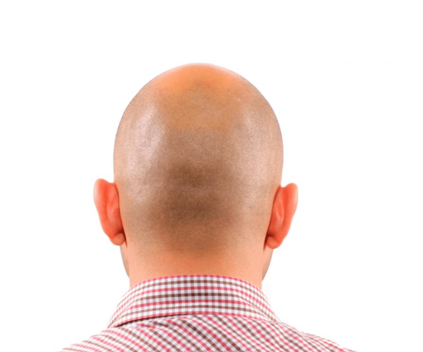 Hair Loss in Young Men