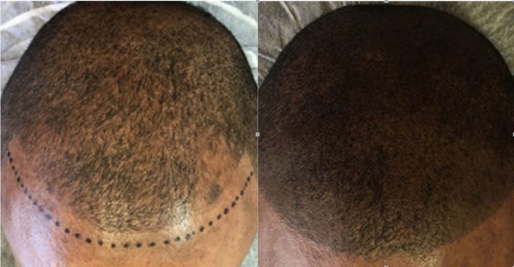 Scalp Micropigmentation