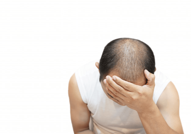 Hair Loss in Men