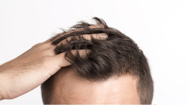 Frequent Hair Loss