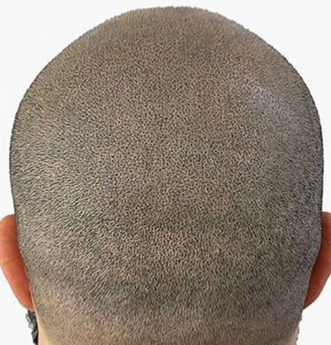 Man After Scalp Micropigmentation