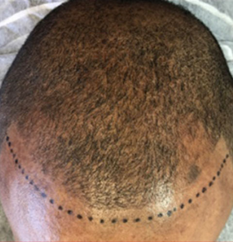 Scalp Micorpigmentation vs. Hair Fibers