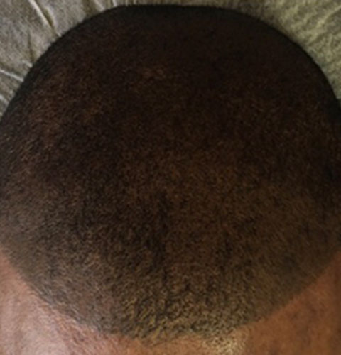 SMP Treatment for Hair Loss