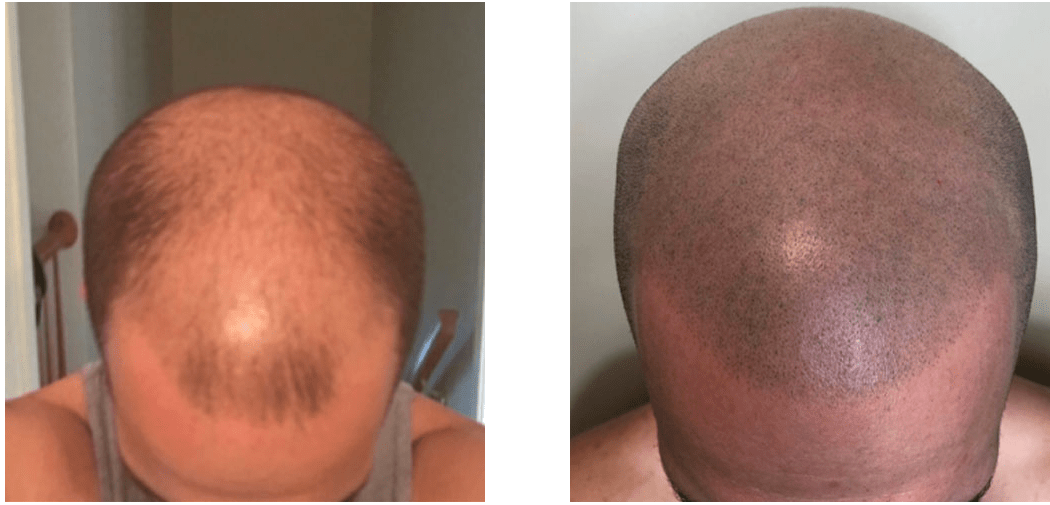 SMP Treatment for Hair Loss