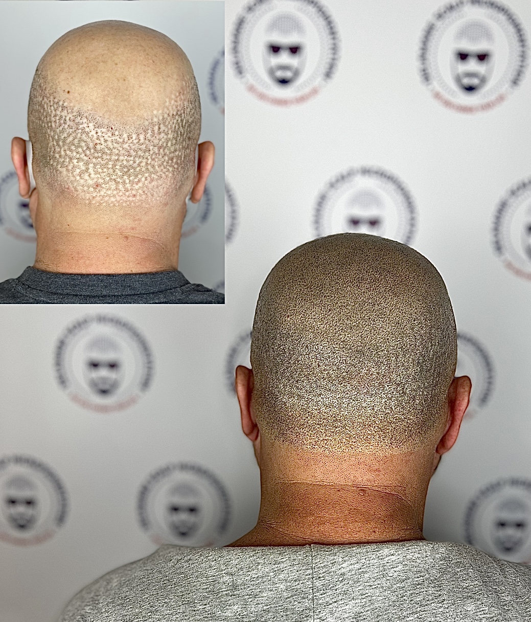 delaware scalp micropigmentation