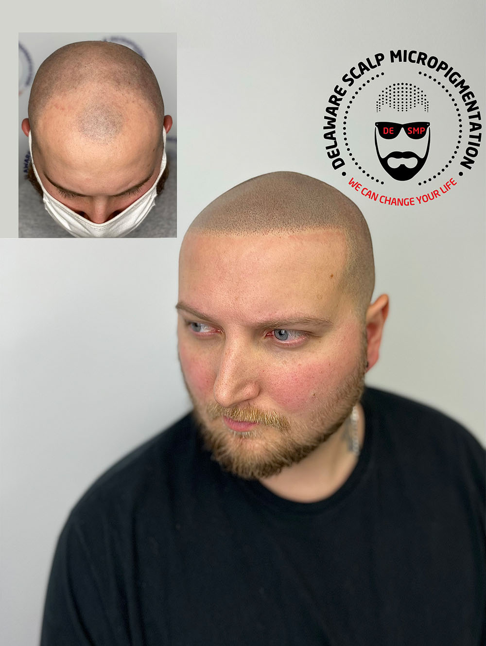 Scalp Micropigmentation Services in Delaware | Delaware Scalp