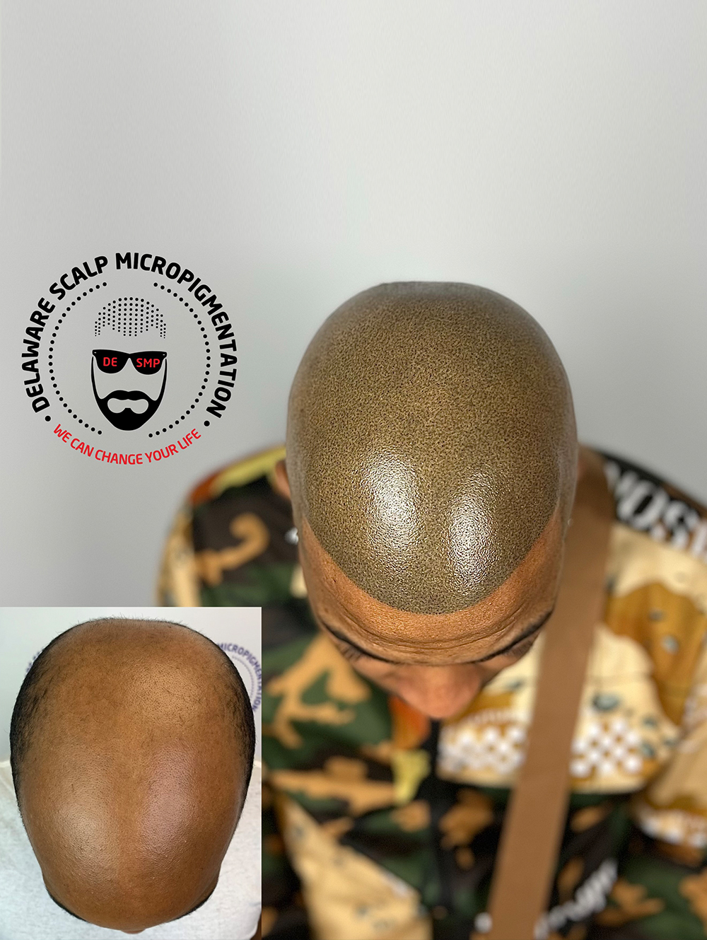 natural scalp micropigmentation