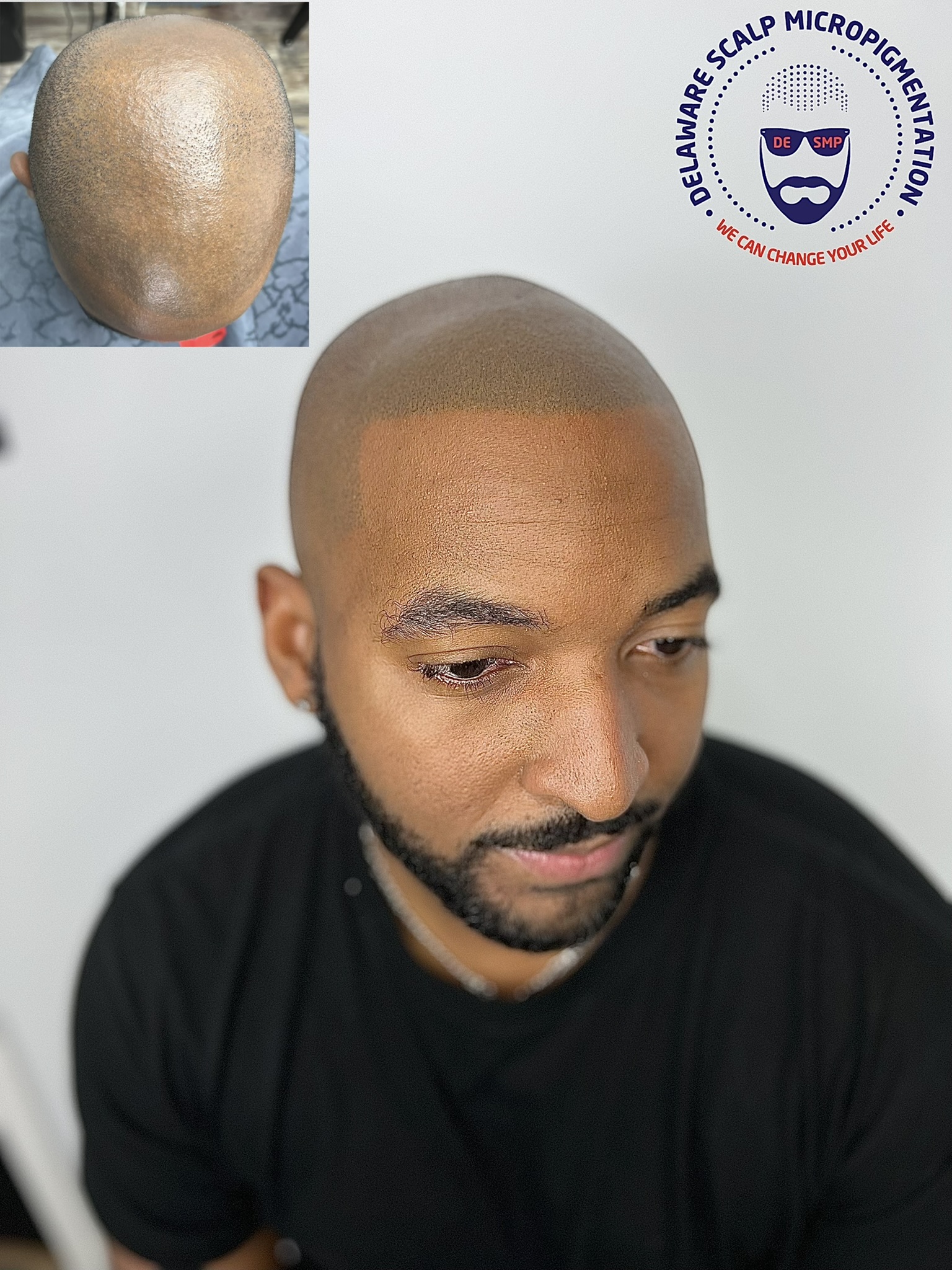 Scalp Micropigmentation Services in Delaware | Delaware Scalp