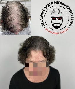 Scalp Micropigmentation