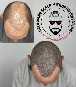 Advantages of Scalp Micropigmentation