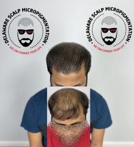 Scalp Micropigmentation