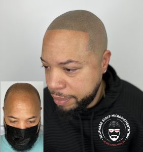 Scalp micropigmentation for men