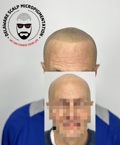 Scalp Micropigmentation Checklist