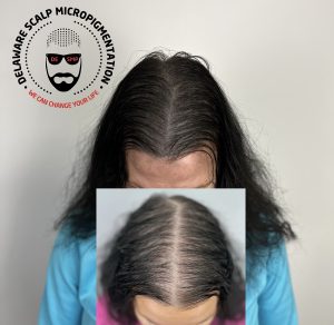 Scalp micropigmentation