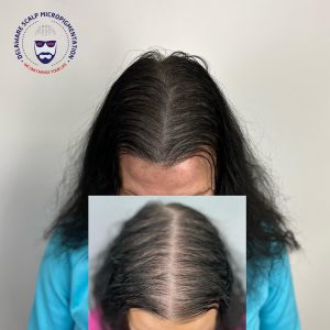 SMP and Hair Transplant