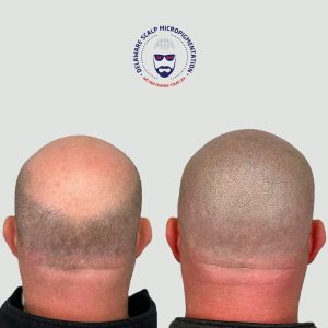 Scalp Micropigmentation