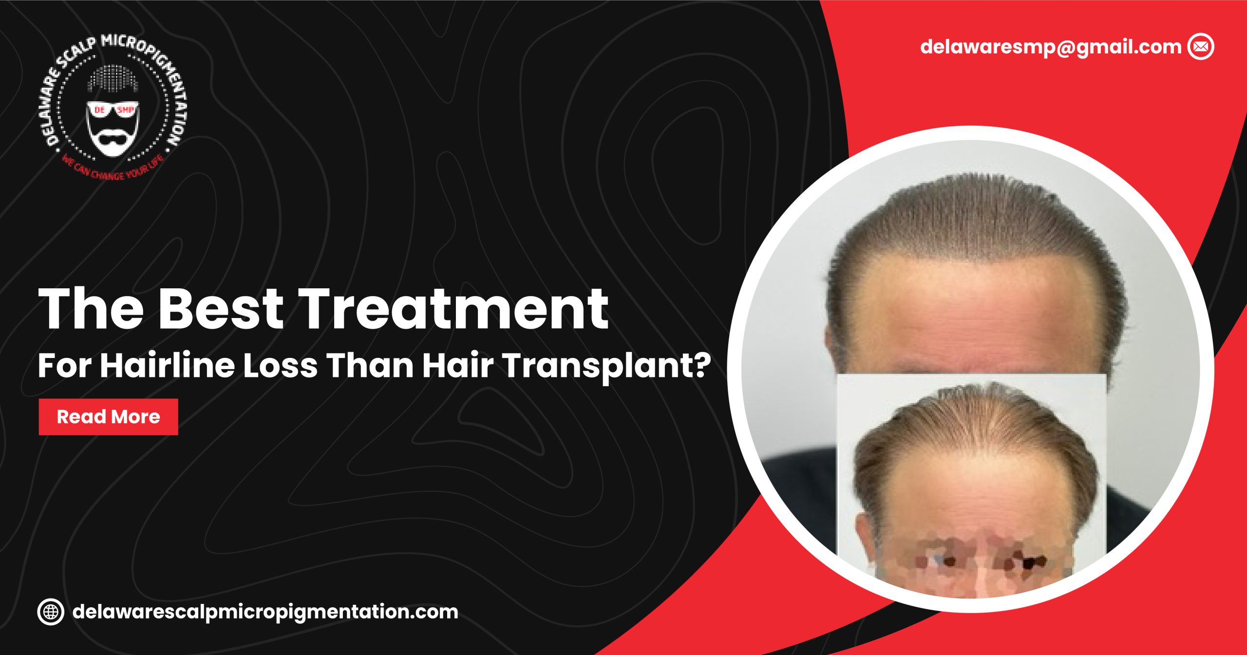 Best Treatment for Hairline Loss