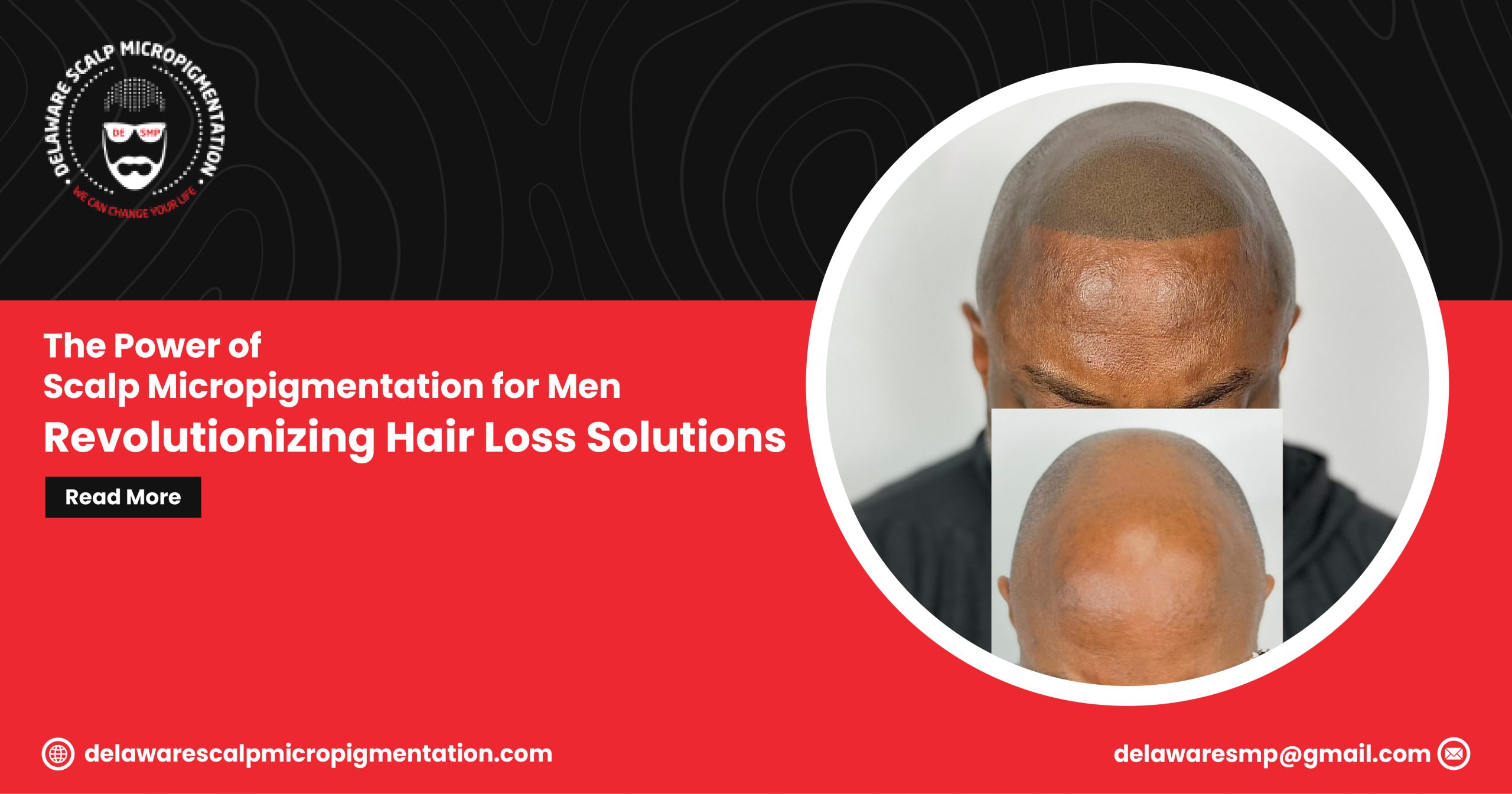 Scalp Micropigmentation for Men