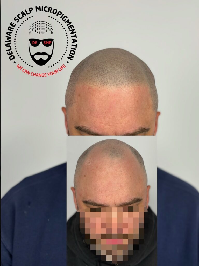 BEST SMP hairline restoration at Delaware SMP by Joey Dots