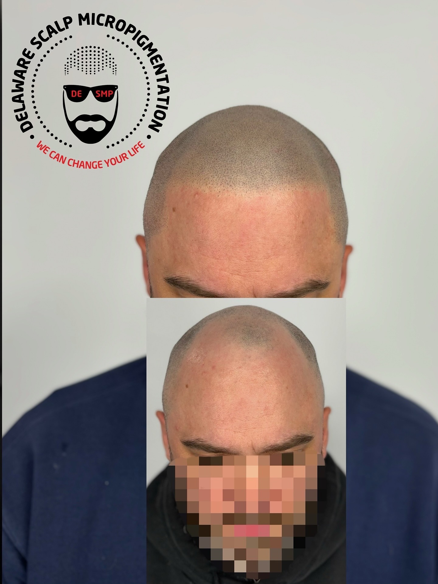 BEST SMP hairline restoration at Delaware SMP by Joey Dots