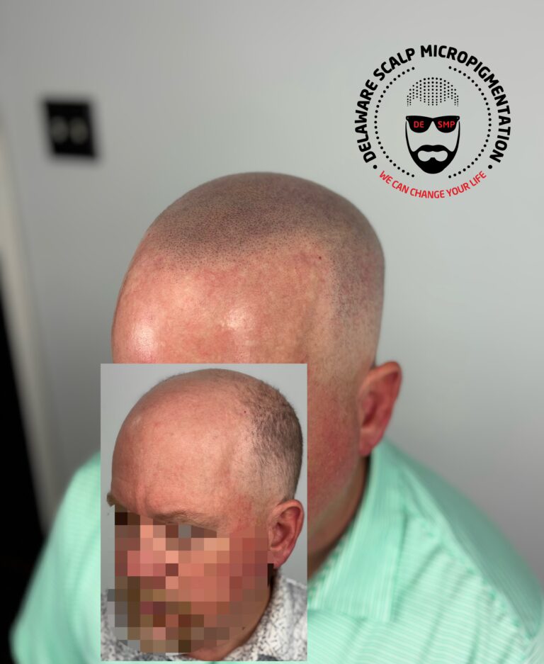 delaware-smp-before-after-hairline-restoration