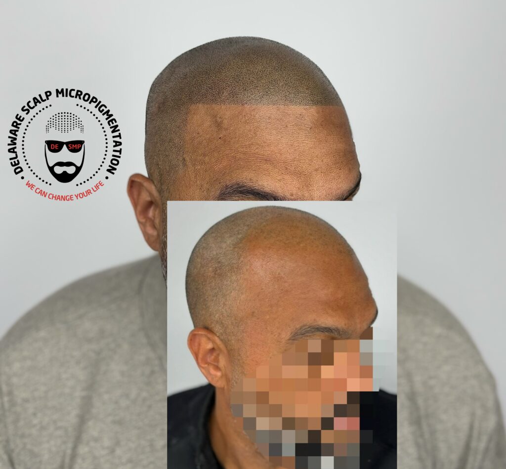 Hairline restoration SMP result at Delaware SMP