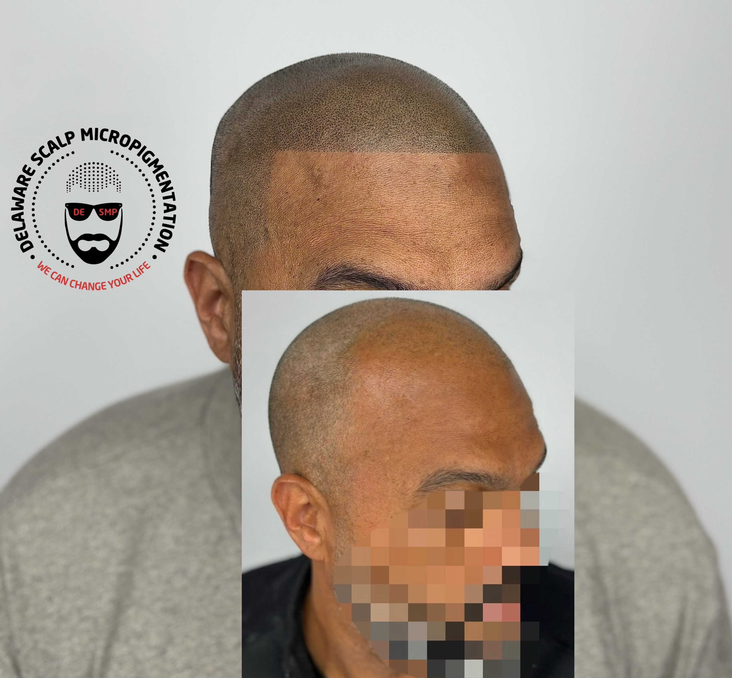 hairline-restoration-smp-results-delaware