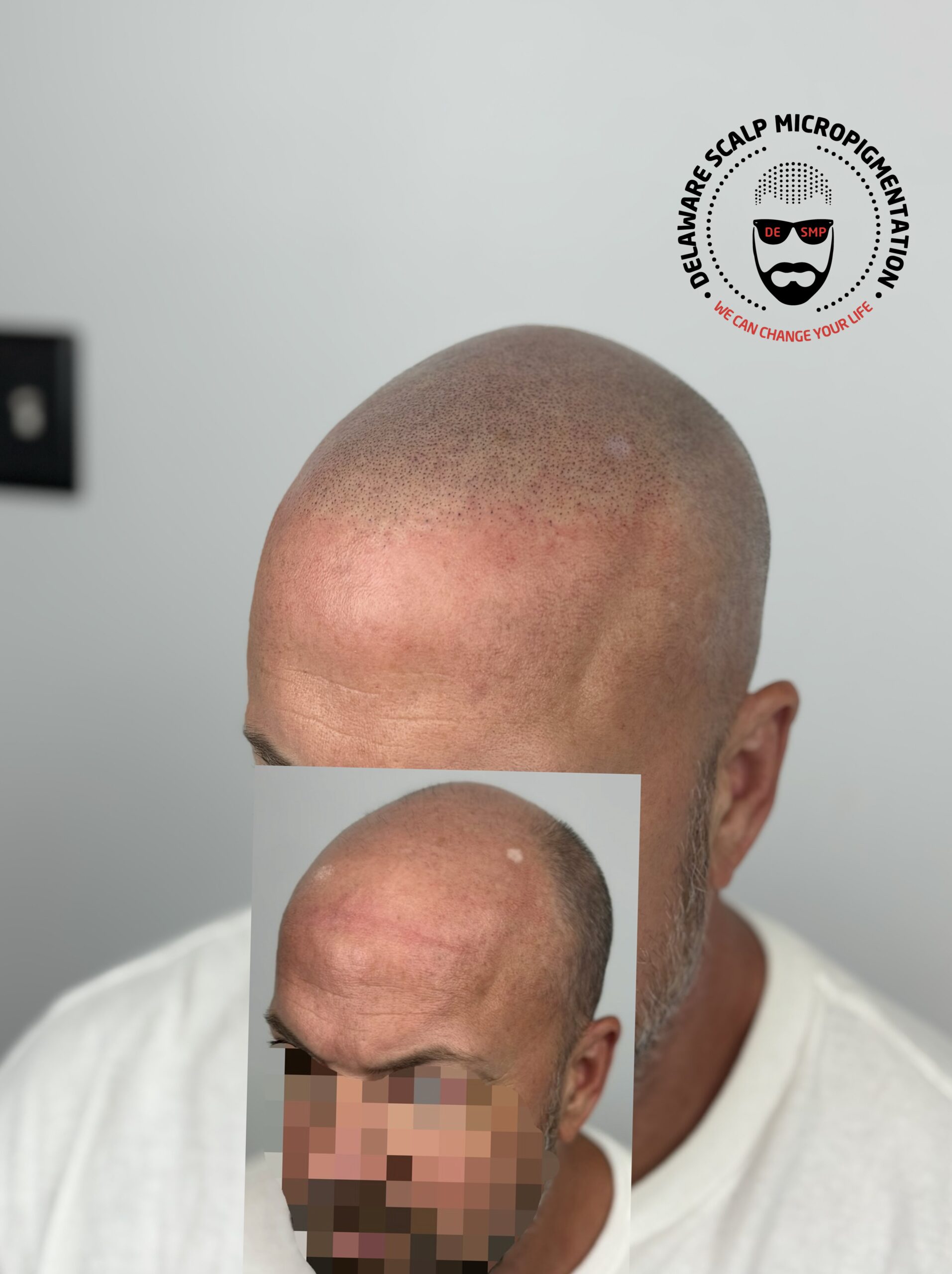 hairline-restored-with-smp-delaware