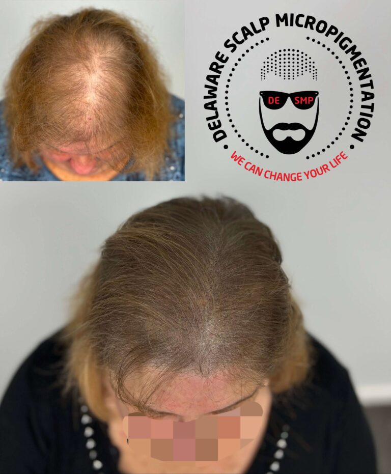 Natural-looking SMP for thinning hair