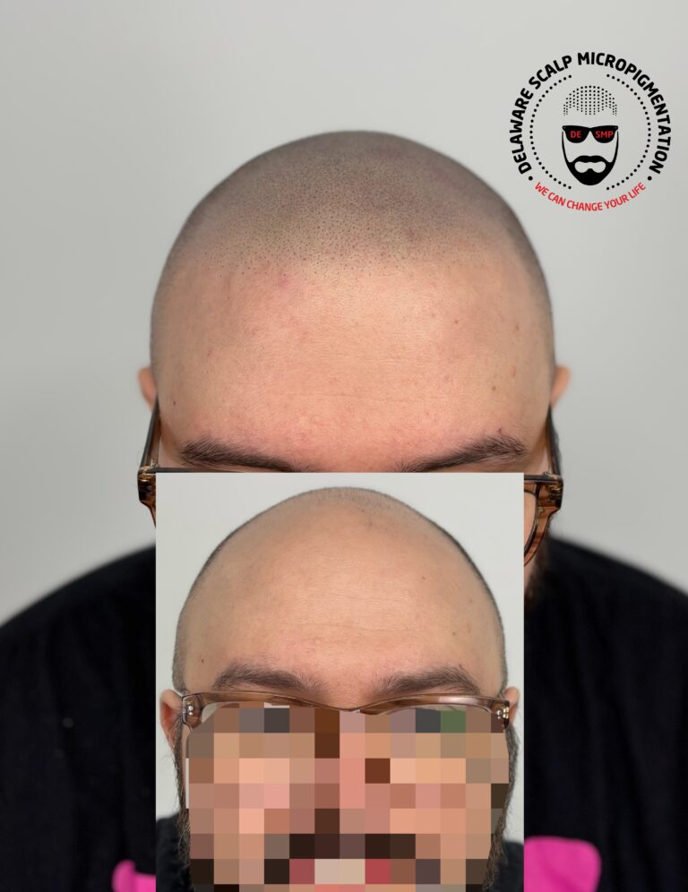 Corrective scalp micropigmentation hairline result at Delaware SMP