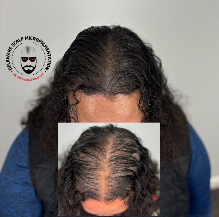 SMP for thinning hair density result at Delaware SMP