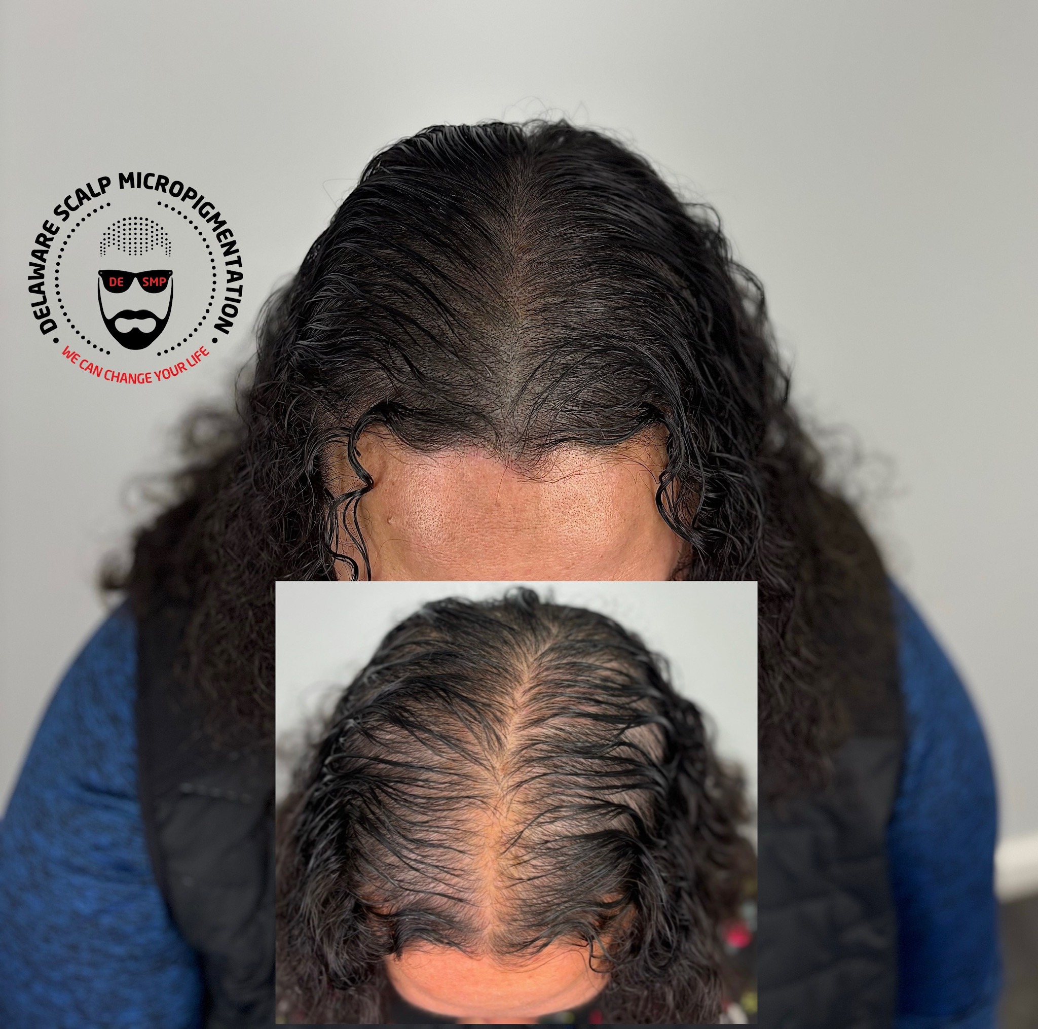 smp-thinning-hair-solution-delaware