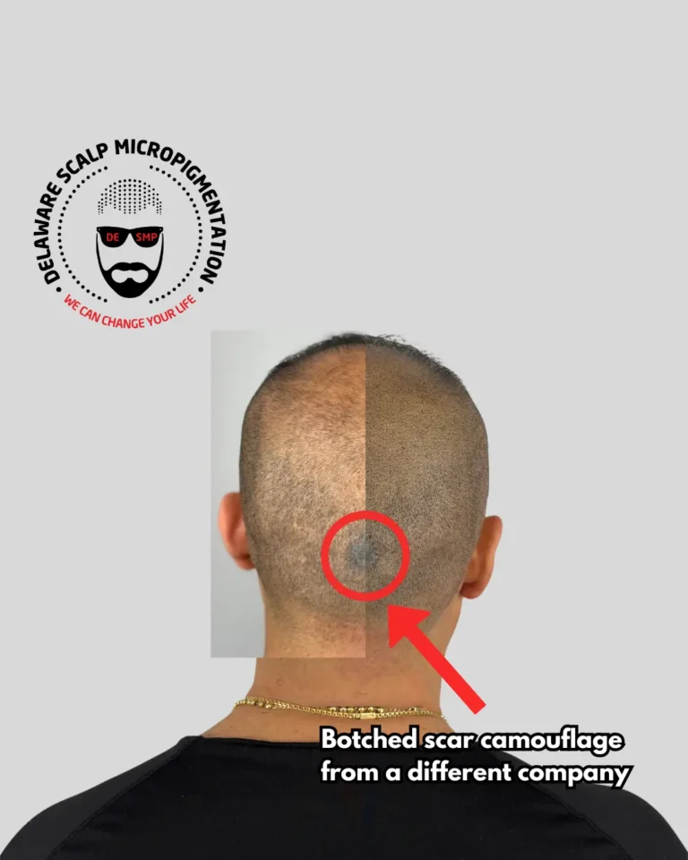 Scalp micropigmentation before and after comparison