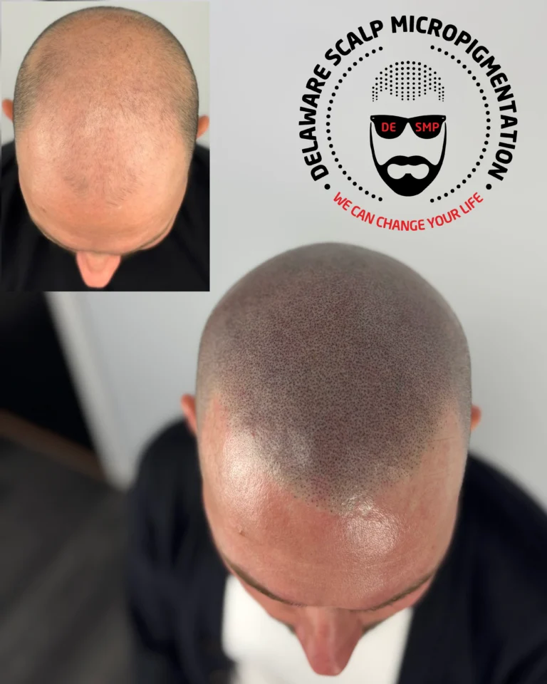 Scalp micropigmentation before and after at Delaware SMP