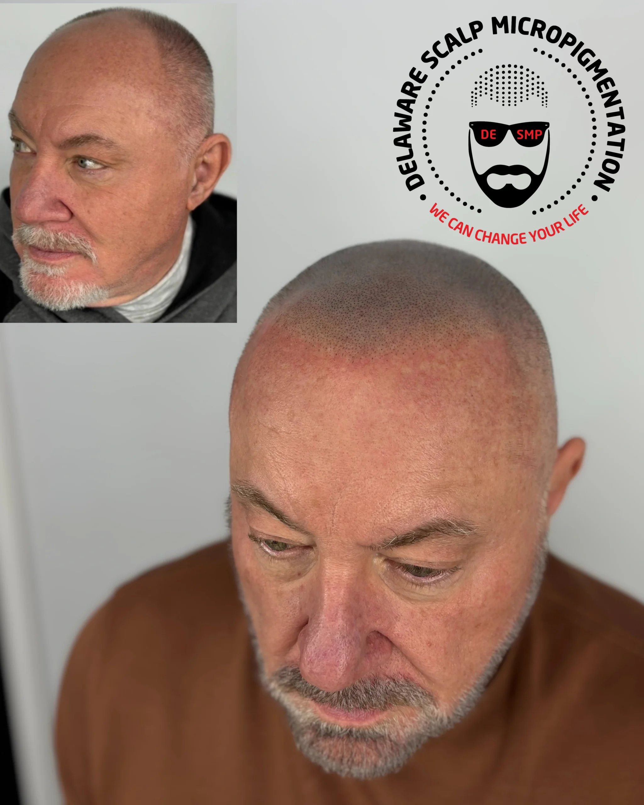 hairline-restoration-smp-before-after-wilmington-delaware