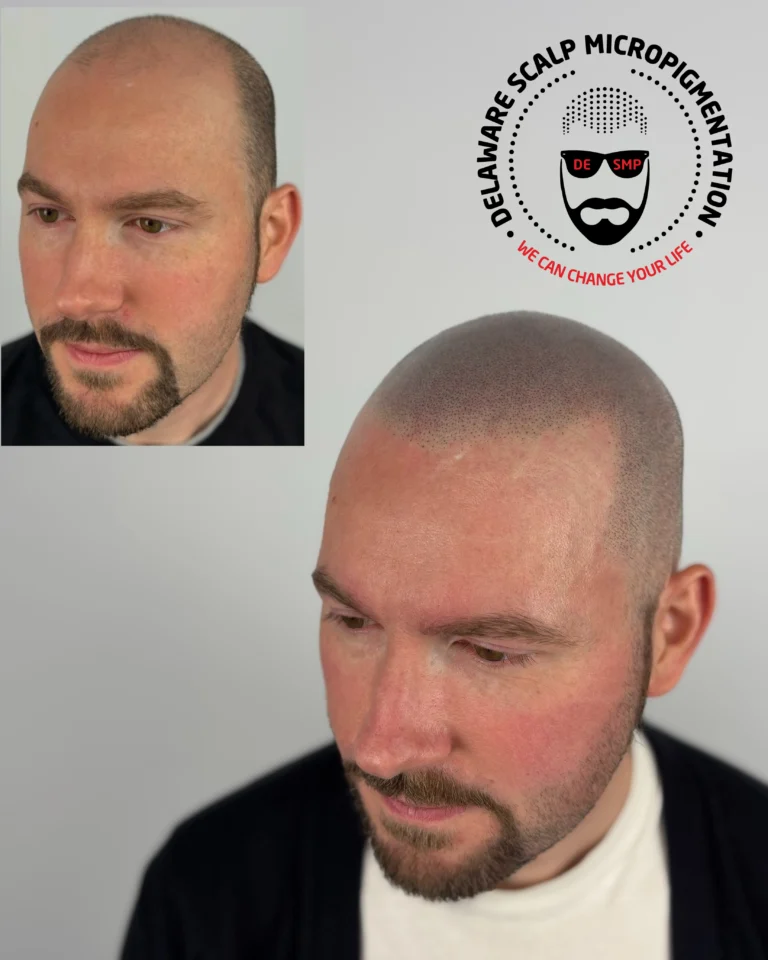 Joey Dots SMP hairline before and after result