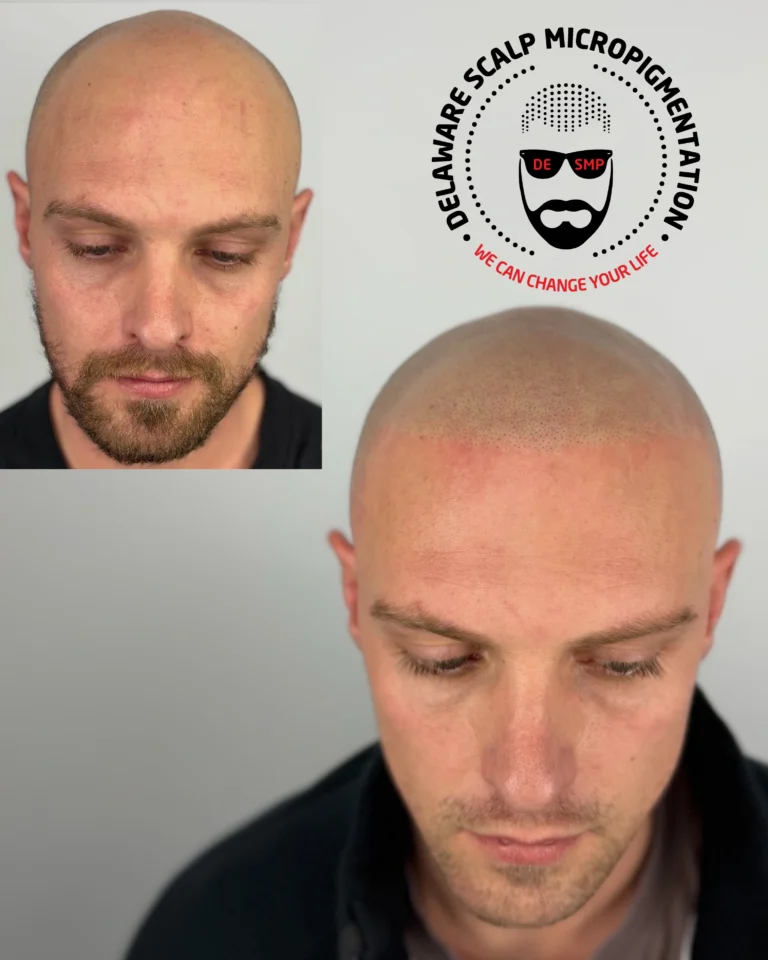 Shaved head SMP before and after result at Delaware SMP