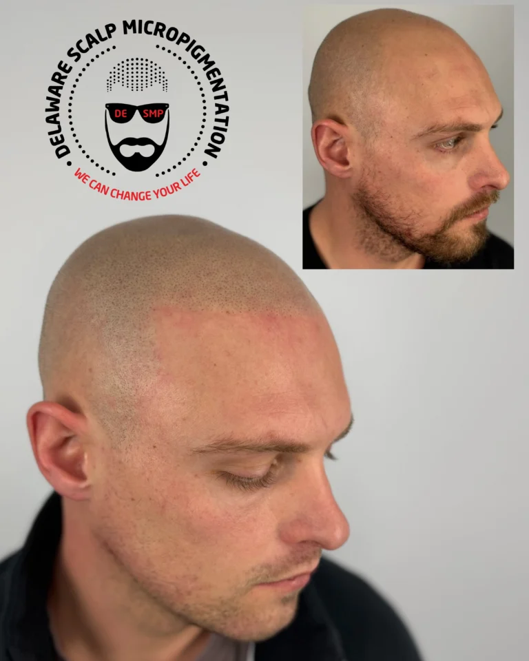 SMP density for thinning hair before and after at Delaware SMP