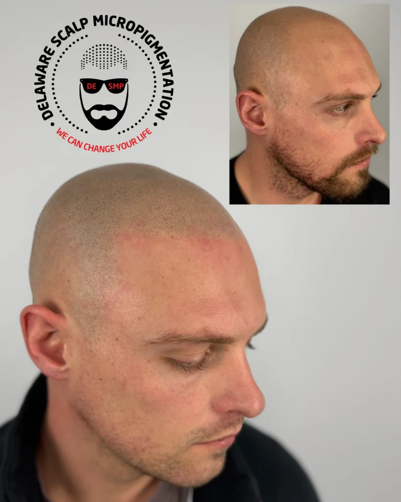 SMP density for thinning hair before and after at Delaware SMP