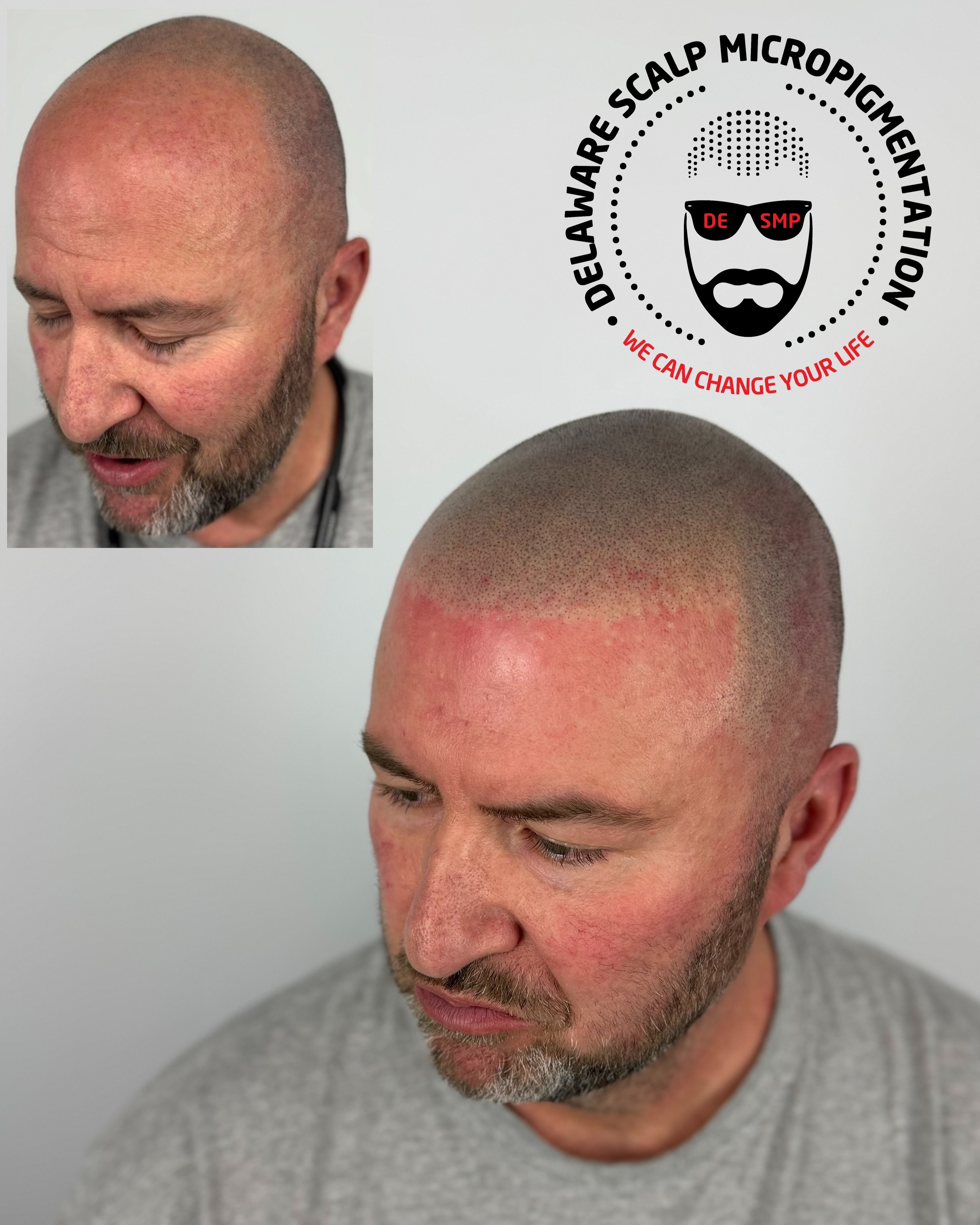 best-scalp-micropigmentation-before-and-after-delaware-smp-joey-dots