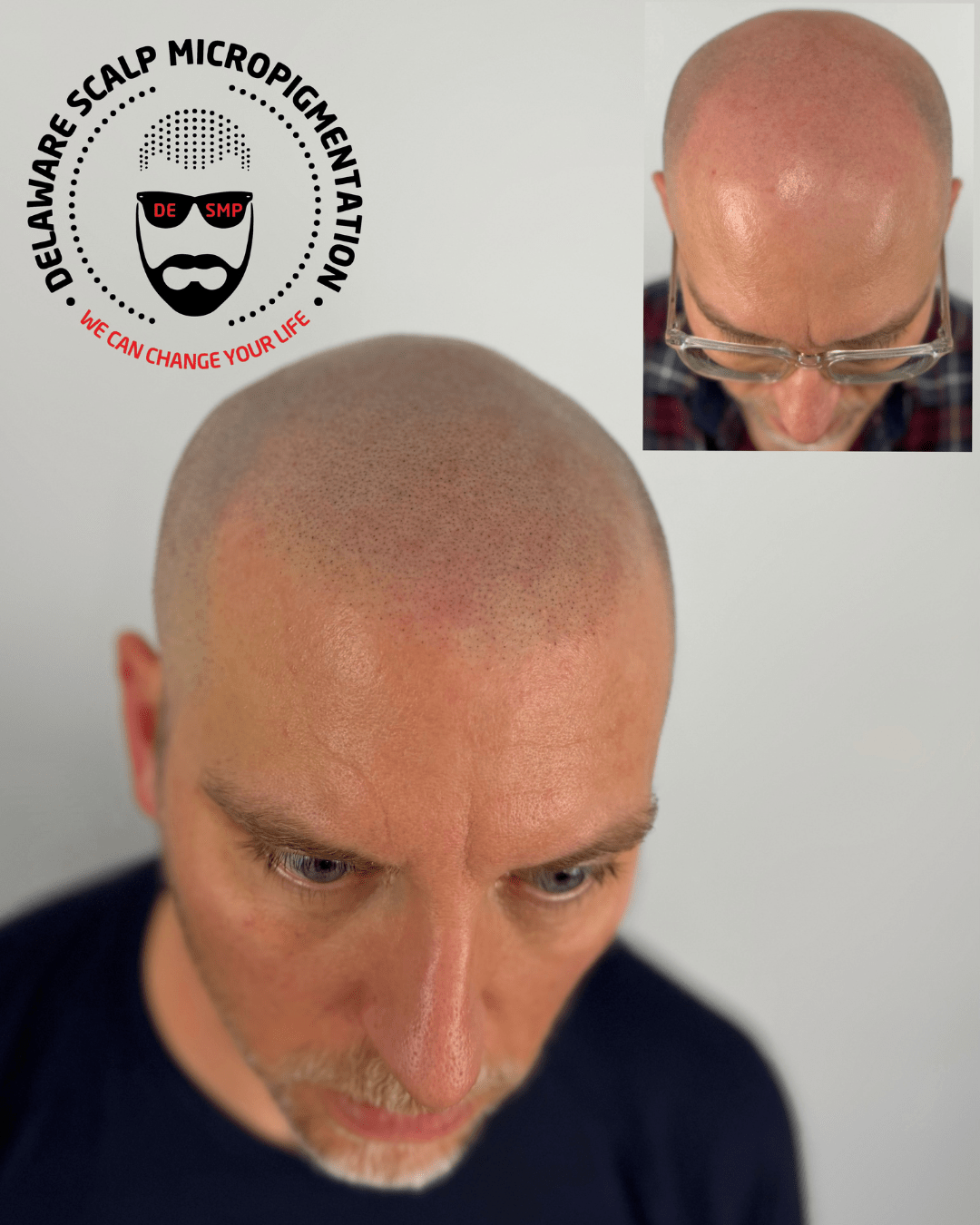 Scalp micropigmentation before and after result by Delaware SMP