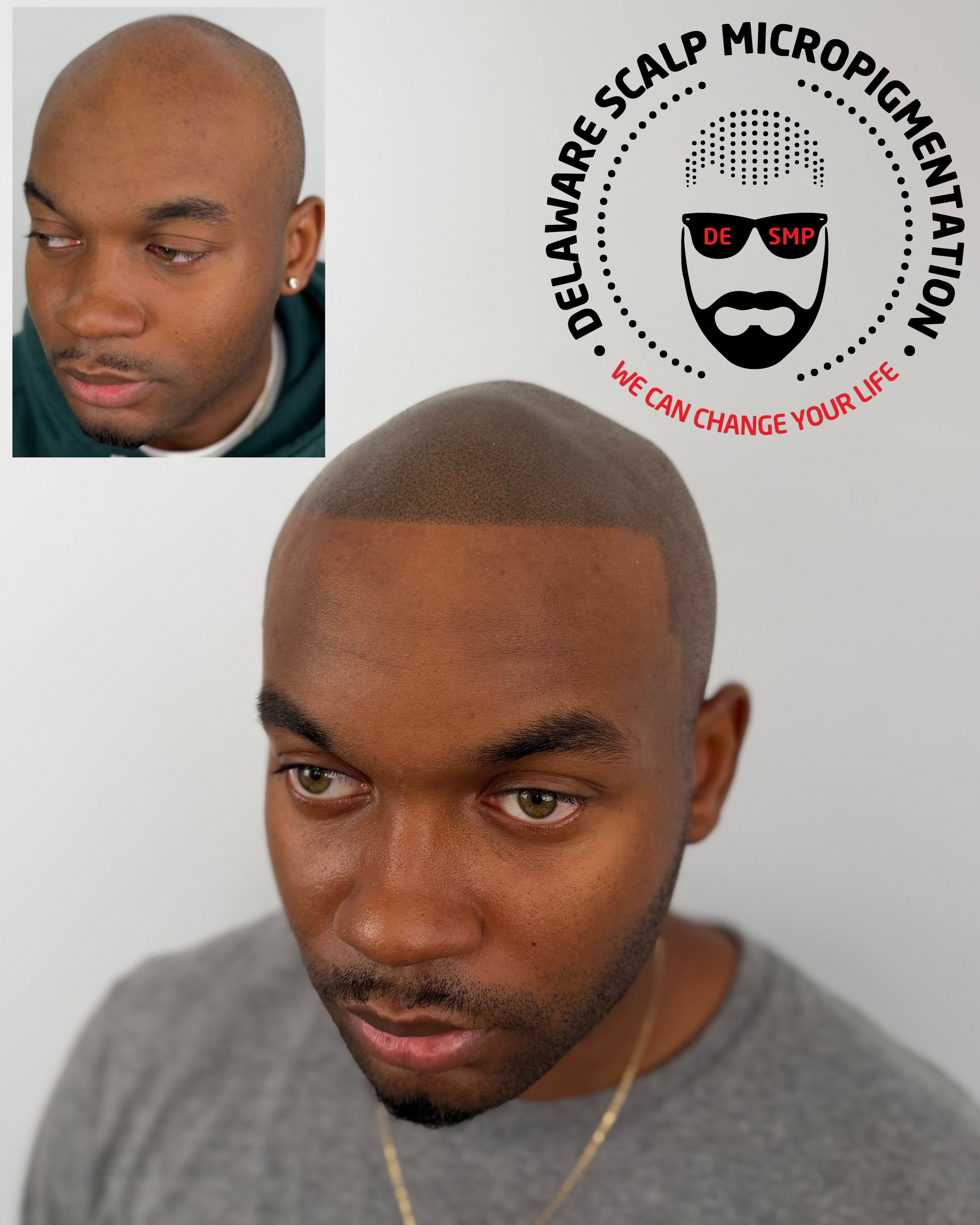 delaware-scalp-micropigmentation-before-after-Joey-Dots-Best-SMP-Artist-in-world