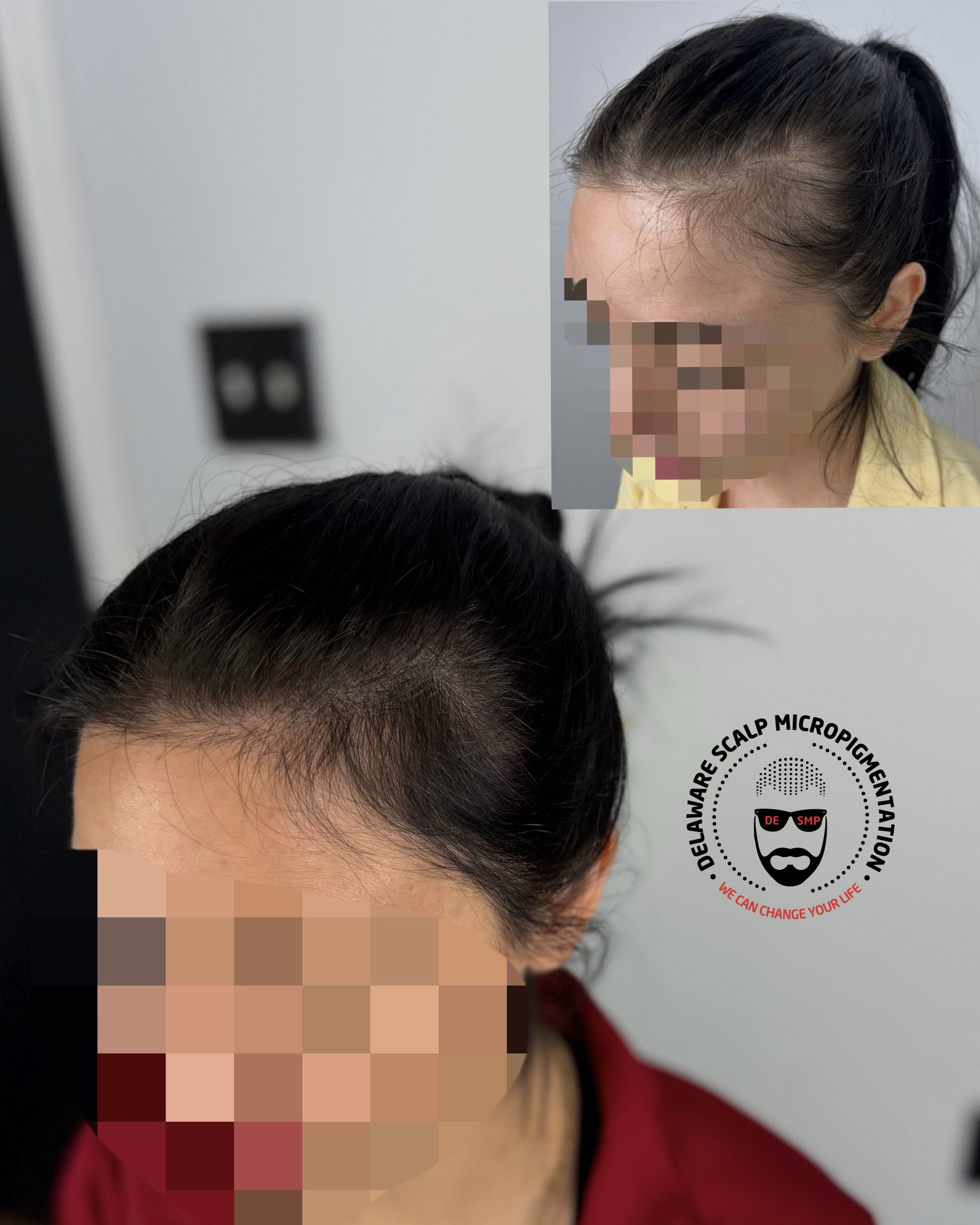 female-scalp-micropigmentation-before-after-thinning-hair-delaware.