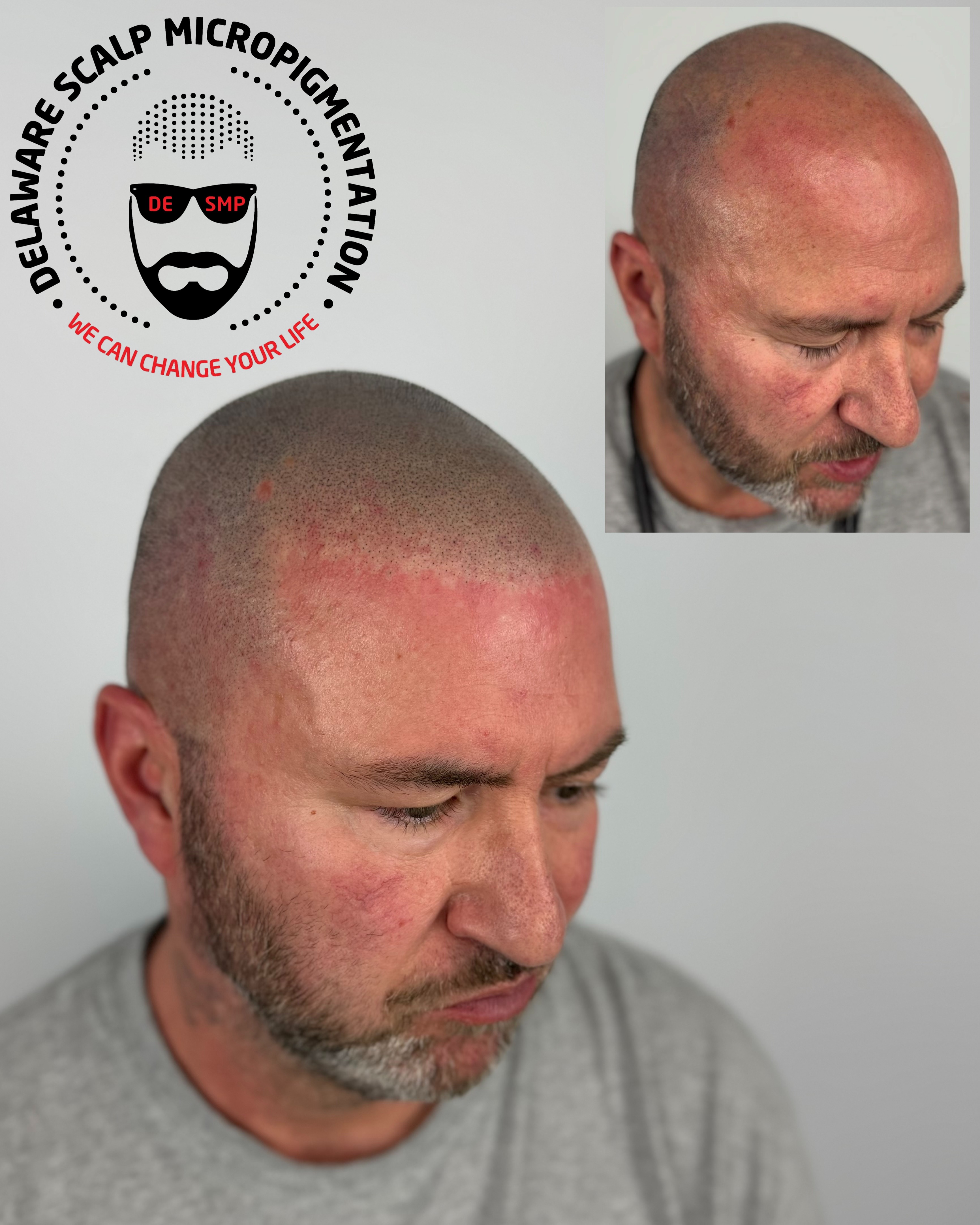 World-Class Hair Transplant Density Fill with SMP